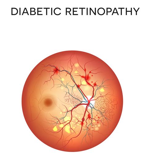 Diabetic Retinopathy Retina Vitreous Consultants Inc