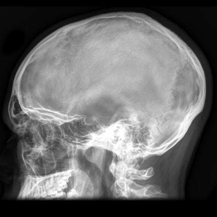 Skull Lateral View Radiology Reference Article Radiopaedia Org