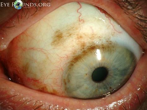 Atlas Entry Primary Acquired Melanosis Pam