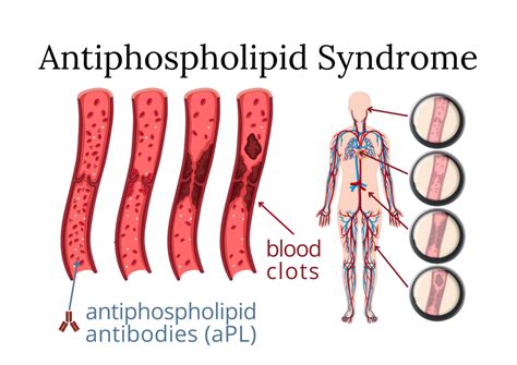 Antiphospholipid Syndrome Ern Reconnet European Reference Network