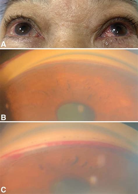 Left Mild Proptosis And Bilateral Corkscrew Episcleral Vessels A