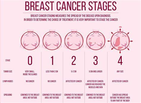 Stage i and ii breast cancers. Breast Cancer, The Most Common Kind of Cancer in Women