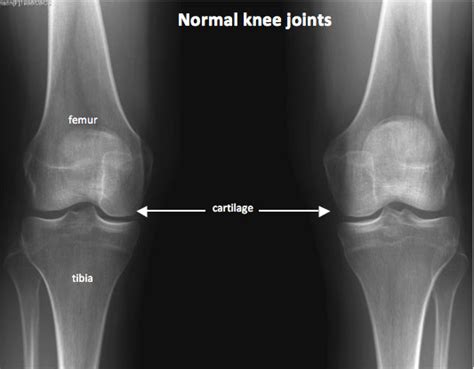 Knee Xray Century City Los Angeles Ca Commons Clinic