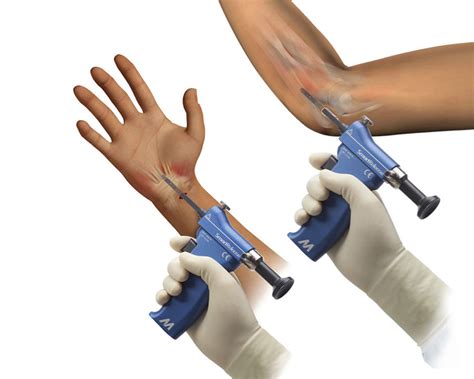 Carpal Cubital Tunnel Murray Surgical