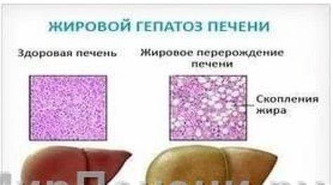 Диета при жировой дистрофии печени Жировой Гепатоз Печени Симптомы И Лечение Диета — Похудение Диета Жировой Гепатоз Печени Симптомы И Лечение Диета — Похудение Диета Диета при жировой дистрофии печени