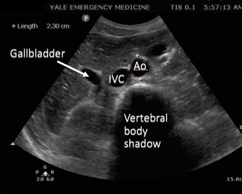 Aorta And Ivc Ultrasound Initial Visualization