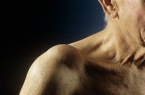 Shoulder Joint Cyst Photograph By Mike Devlinscience Photo Library