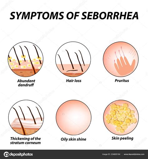 Symptoms Seborrhea Seborrhea Skin Hair Dandruff Seborrheic Dermatitis