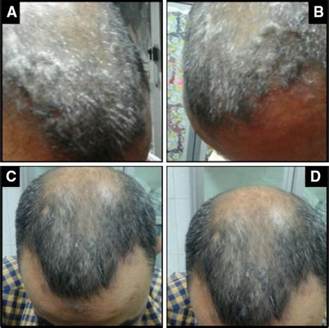 scalp psoriasis before and after treatment download scientific diagram