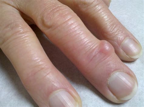 Cyst Near Fingernail Bed Nail Ftempo