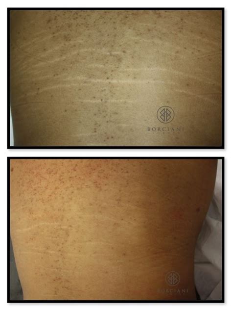 Stretch Mark Removalreduction Incredible Results Using Digital Skin