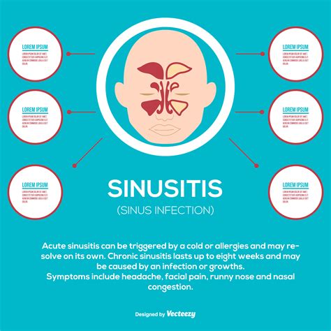 Sinusitis Infographic Illustration Download Free Vector Art Stock