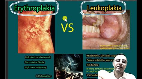 Erythroplakia Vs Leukoplakia Symptoms Causes Risk Of Malignancies