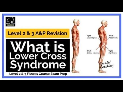 Lower Crossed Syndrome Medical Diagram Crooked Man Muscle Strength