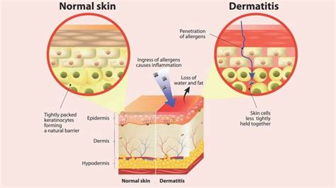 Causes Of Skin Rash 1md Nutrition™