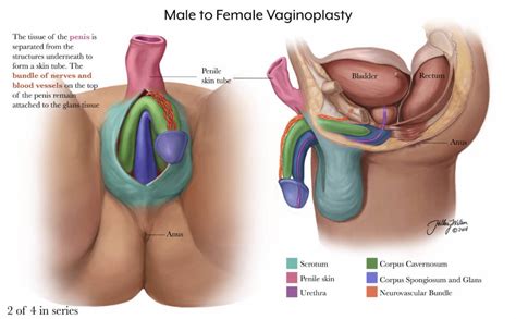 Vaginoplasty For Gender Affirmation Johns Hopkins Medicine