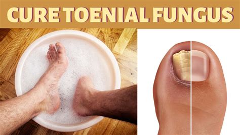 Bleach Foot Soak To Get Rid Of Toenail Fungus Naturally Fast And Permanently At Home Youtube