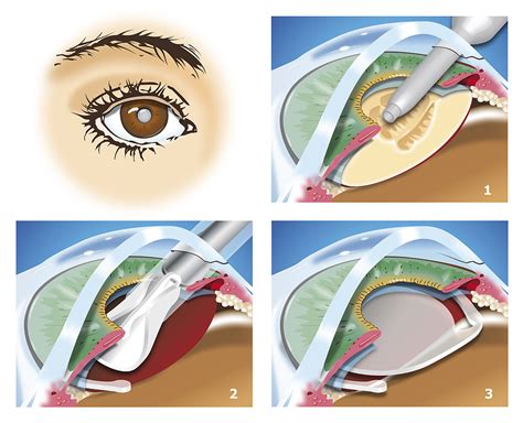 Treatment For Cataracts Burbank Ca A Center For Visioncare