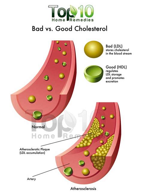 Best Internet Zone Remedies For High Cholesterol