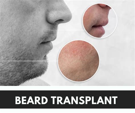 Everything To Know About Beard Transplant Procedure And Cost
