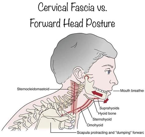 Physioosteobook Cervical Fascia Vs Forward Head Posture