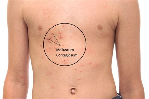 Molluscum Contagiosum In Children Causes And Treatment