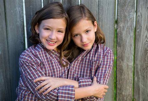 conjoined twins types causes signs and treatment