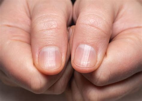 Nail Problems Due To Vitamin Deficiency Mighty Goodness