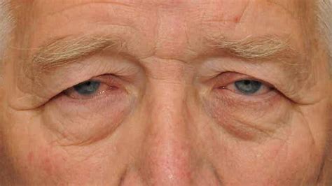 Natural Remedies For Sagging Eyelids Step To Health