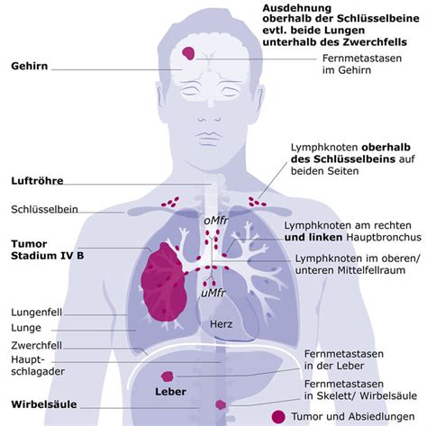 Lungenkrebs Symptome Verlauf Therapie Apotheken Umschau