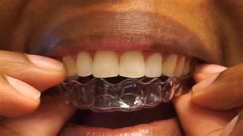 It S Here 2 Weeks Without A Retainer Before And After Life After Braces Youtube