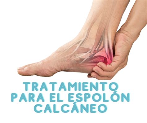 Qué es el espolón calcáneo AD Fisioterapia Valencia