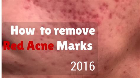 How To Remove Red Marks From Acne Youtube