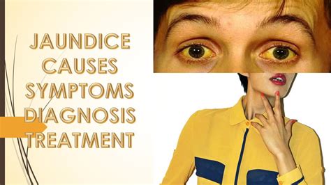 Jaundice Causessign Symptomstreatment And Risk Factor Youtube