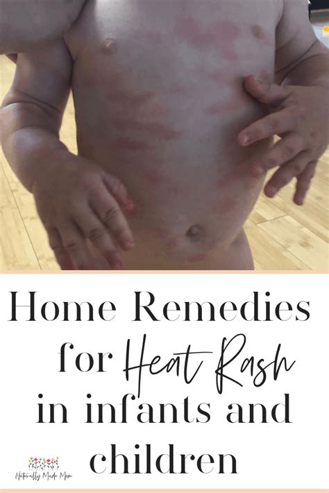 5 Best Home Remedies For Baby Heat Rash Naturally Made Mom