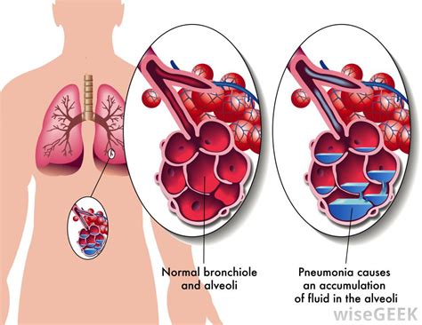 What Is Clinical Pneumonia With Pictures
