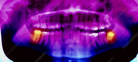Coloured Pan Oral X Ray Of An Erupted Wisdom Tooth Stock Image M780