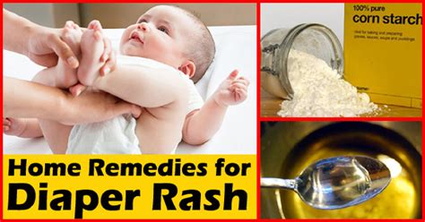 13 Remedies To Treat Diaper Rash In Babies And Prevention Tips