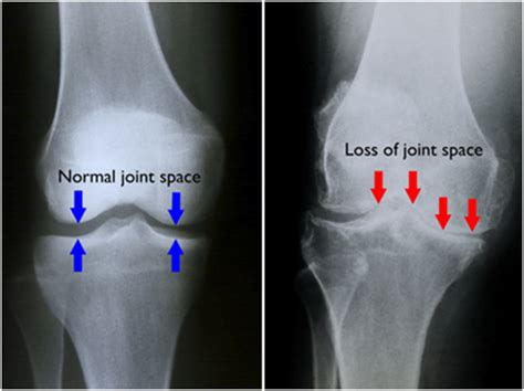Arthritis Of The Knee Types Symptoms Diagnosis And Treatment