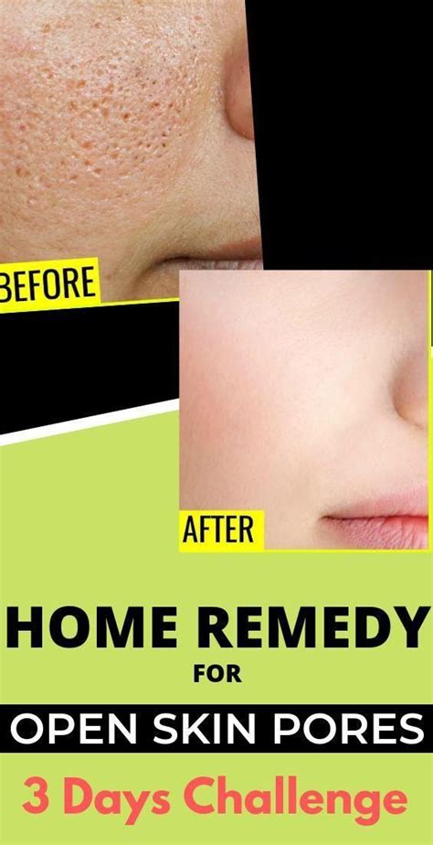 3 Easy Home Remedies And Large Skin Pores Will Disappear From Your Face