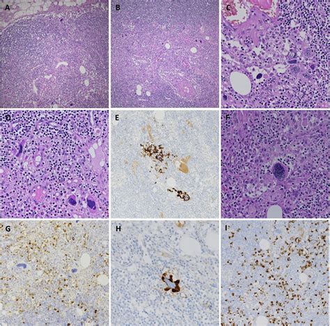 Unusual Pleomorphic Cells In Axillary Lymph Node Journal Of Clinical