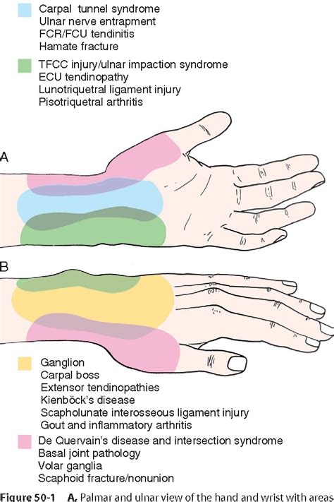 Figure 50 1 From Common Etiologies For Hand And Wrist Pain