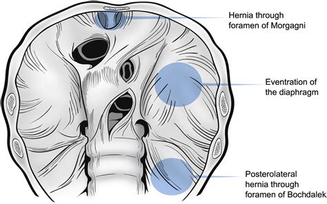 Surgical Conditions Of The Diaphragm Posterior Diaphragmatic Hernias
