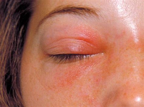 Rashes Around The Eye Renew Physical Therapy