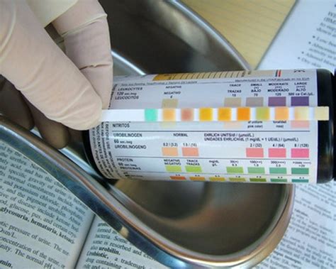 What Is Normal Amount of Protein in Urine? | Livestrong.com