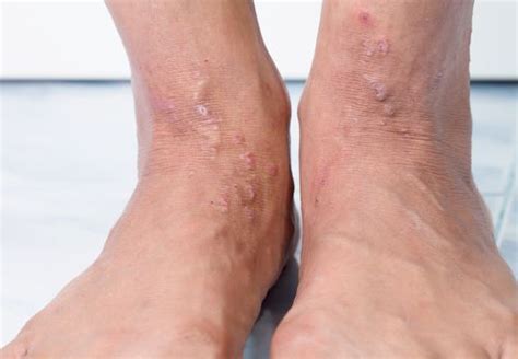 Psoriasis On Top Of Feet