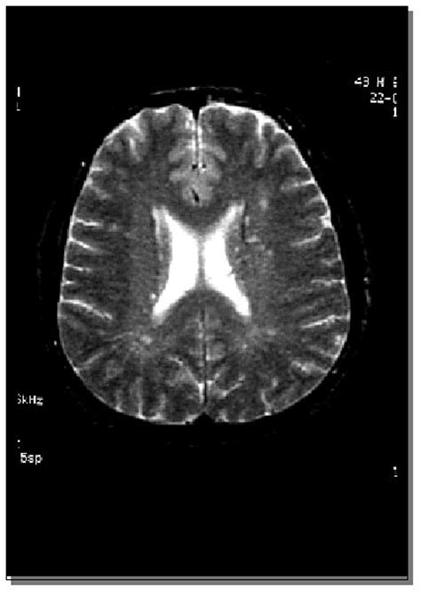 Brain Lesions March 2015