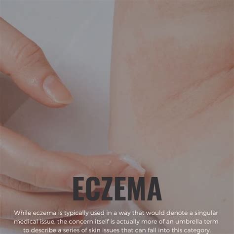 There Are Three Common Forms Of Eczema Atopic Dermatitis Which Causes