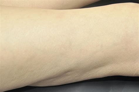 Sclerotherapy Treatments In Weymouth Ma Gk Derm
