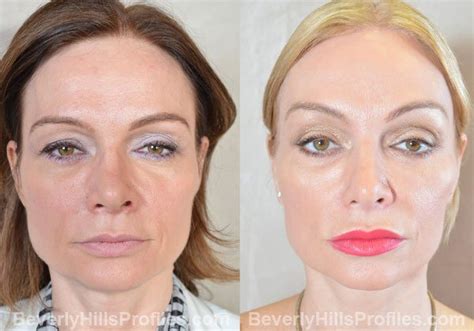 Before and after a brow lift procedure. Eyelid Lift Before & After Photos